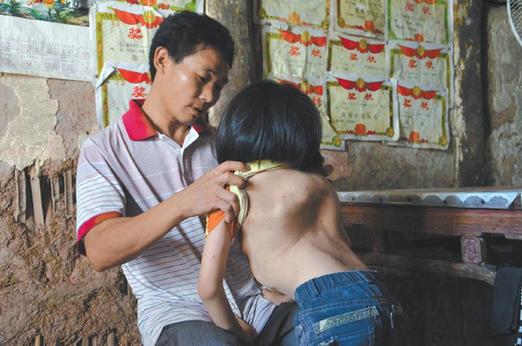 有嚴重脊椎畸形及胸腔隆突病的李文霞。