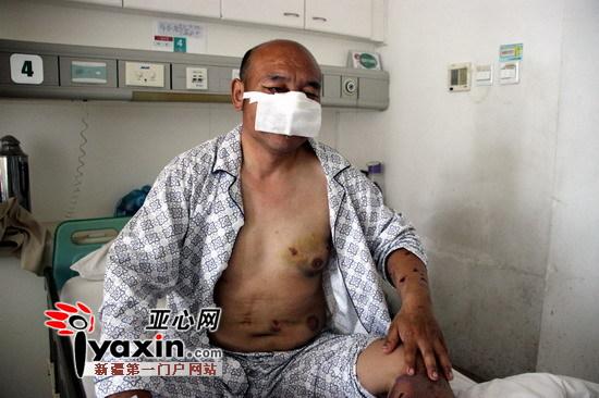 新疆沙灣村民山中撿玉遭棕熊攻擊 鼻子、上嘴唇被咬掉撿回一命（圖）
