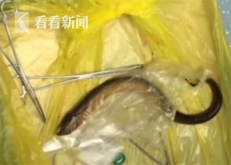 黃鱔從肛門鉆進肚子 男子被送醫不愿多談事情經過