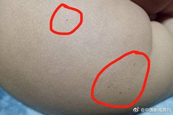 據多名紅黃藍(新天地分園)家長反映，孩子腿部、屁股、腋下出現針眼。