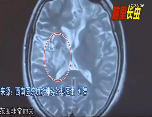 少女大腦皮層萎縮 醫(yī)生從她腦子里捉出5厘米蟲(chóng)子