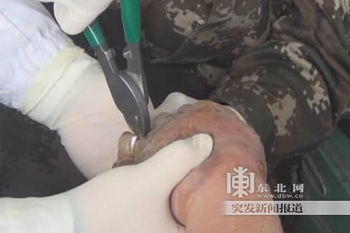 正在拆除戒指。
